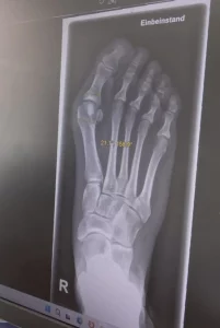 Anästhesiegespräch Hallux-Valgus-OP