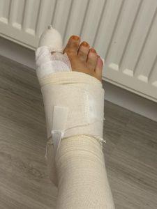 Hallux-Valgus-OP