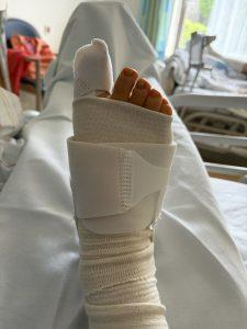 Verband nach Hallux-valgus-OP