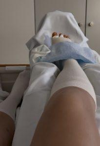kühlen bei Hallux-OP
