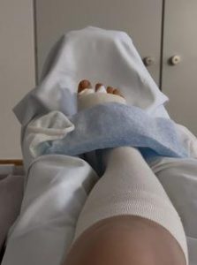 kühlen bei Hallux-Valgus-OP
